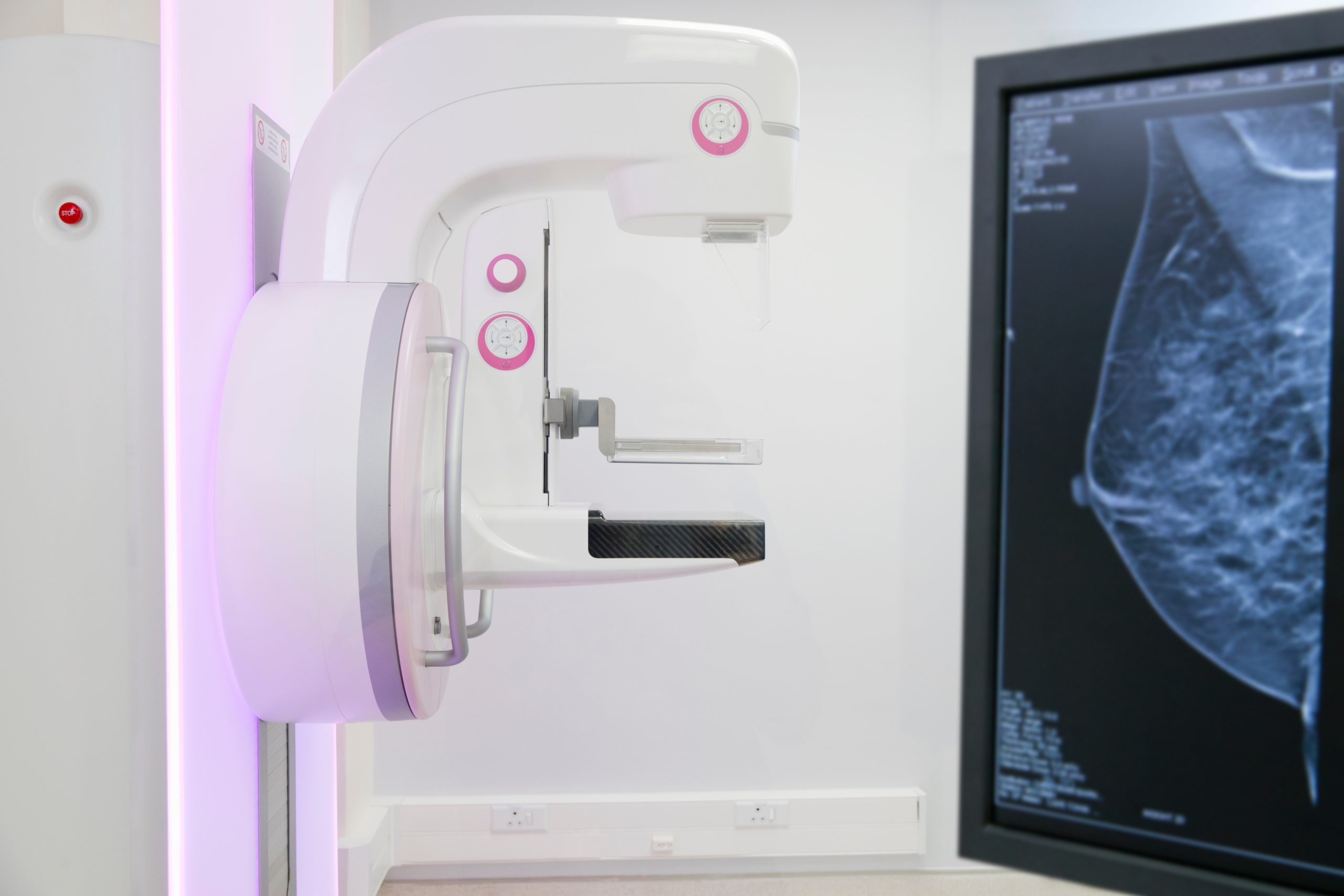 Mamografia – Número de exames cai pela metade na pandemia