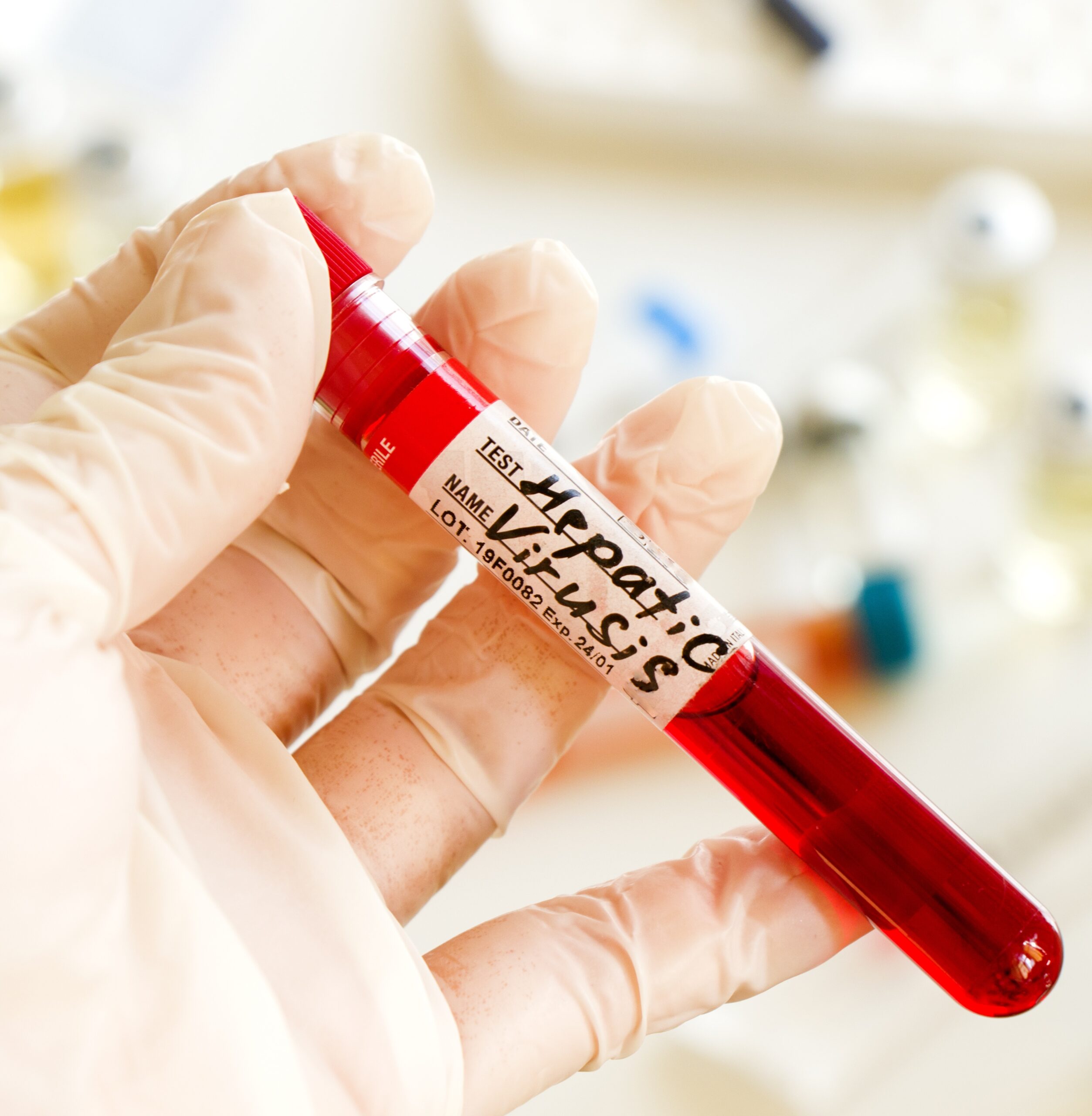 Hepatites Virais: Brasil quer diagnosticar 90% dos casos até 2030. Como avançar?